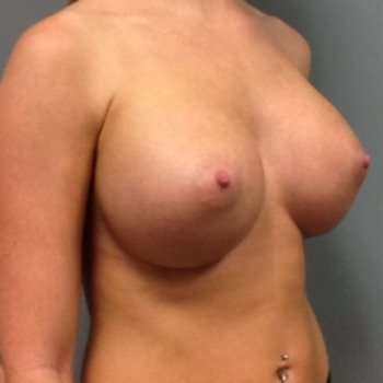 Breast Augmentation Before & After Patient #735