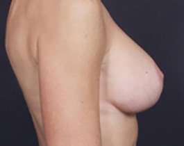 Breast Mastopexy Before & After Patient #141