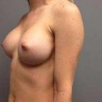 Breast Augmentation Before & After Patient #778