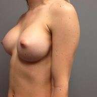 Breast Augmentation Before & After Patient #778