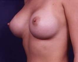 Breast Augmentation Before & After Patient #818