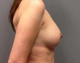 Breast Augmentation Before & After Patient #853