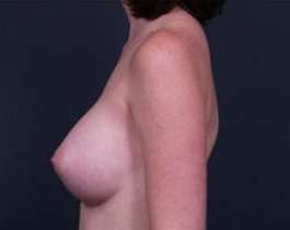 Breast Augmentation Before & After Patient #861