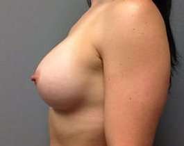 Breast Augmentation Before & After Patient #878