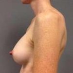 Breast Augmentation Before & After Patient #885