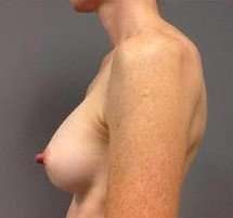 Breast Augmentation Before & After Patient #885