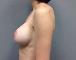 Breast Augmentation Before & After Patient #892