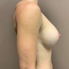 Breast Augmentation Before & After Patient #940