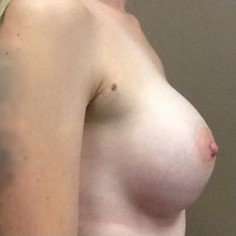 Breast Augmentation Before & After Patient #952