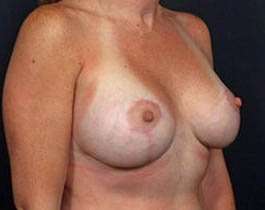 Breast Mastopexy Before & After Patient #162