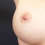 Breast Miscellaneous Before & After Patient #75