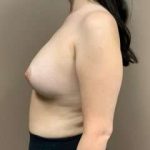 Breast Augmentation Before & After Patient #1063