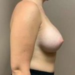 Breast Augmentation Before & After Patient #1128