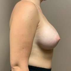Breast Augmentation Before & After Patient #1128
