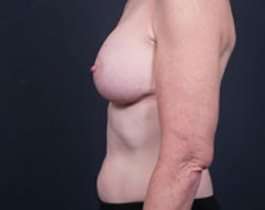 Breast Mastopexy Before & After Patient #183