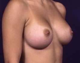 Breast Augmentation Before & After Patient #1210