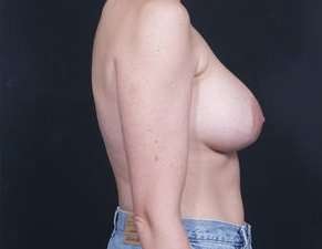 Breast Asymmetry Before & After Patient #1225