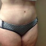Tummy Tuck Before & After Patient #1233