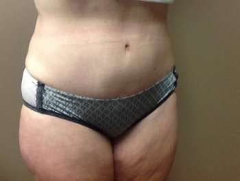 Tummy Tuck Before & After Patient #1233