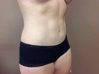 Tummy Tuck Before & After Patient #1238
