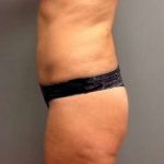 Tummy Tuck Before & After Patient #1243