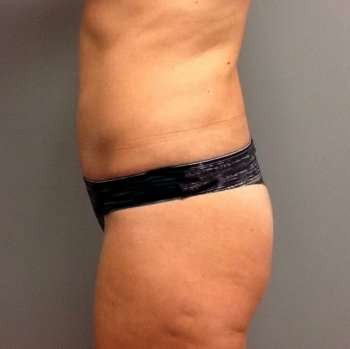 Tummy Tuck Before & After Patient #1243