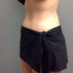 Tummy Tuck Before & After Patient #1251
