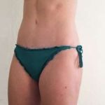 Tummy Tuck Before & After Patient #1256