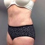 Tummy Tuck Before & After Patient #1263