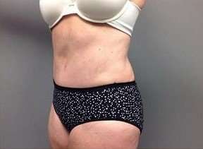 Tummy Tuck Before & After Patient #1263