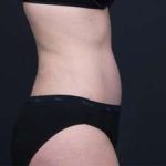 Tummy Tuck Before & After Patient #1270