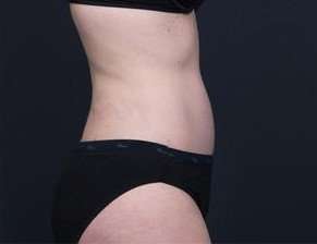 Tummy Tuck Before & After Patient #1270