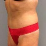 Tummy Tuck Before & After Patient #1277