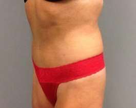 Tummy Tuck Before & After Patient #1277