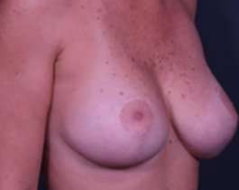 Breast Mastopexy Before & After Patient #197