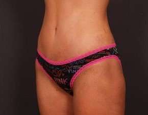 Tummy Tuck Before & After Patient #1284