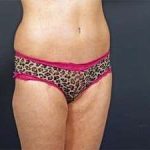 Tummy Tuck Before & After Patient #1289