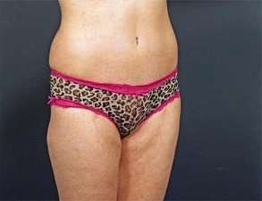 Tummy Tuck Before & After Patient #1289