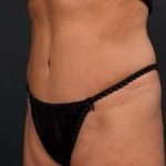 Tummy Tuck Before & After Patient #1296