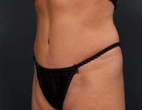 Tummy Tuck Before & After Patient #1296