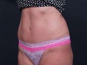 Tummy Tuck Before & After Patient #1303