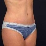 Tummy Tuck Before & After Patient #1310