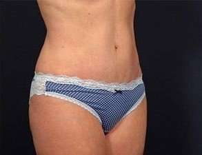 Tummy Tuck Before & After Patient #1310
