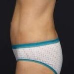 Tummy Tuck Before & After Patient #1315