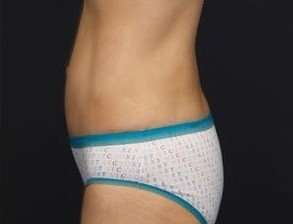 Tummy Tuck Before & After Patient #1315