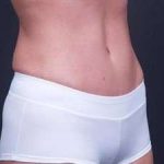 Tummy Tuck Before & After Patient #1322