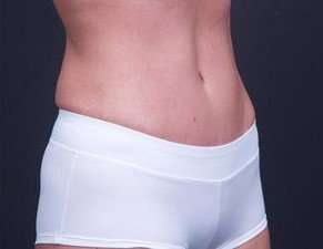 Tummy Tuck Before & After Patient #1322