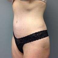 Tummy Tuck Before & After Patient #1327
