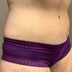 Tummy Tuck Before & After Patient #1332