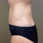 Tummy Tuck Before & After Patient #1349